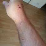 An injured samoyed owner after a pitbull attack